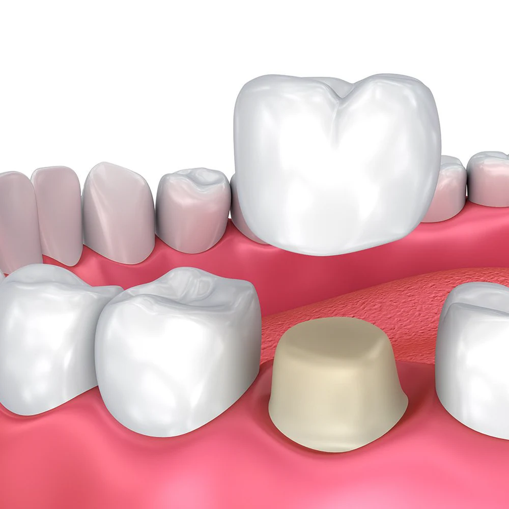 CeramicCrowns