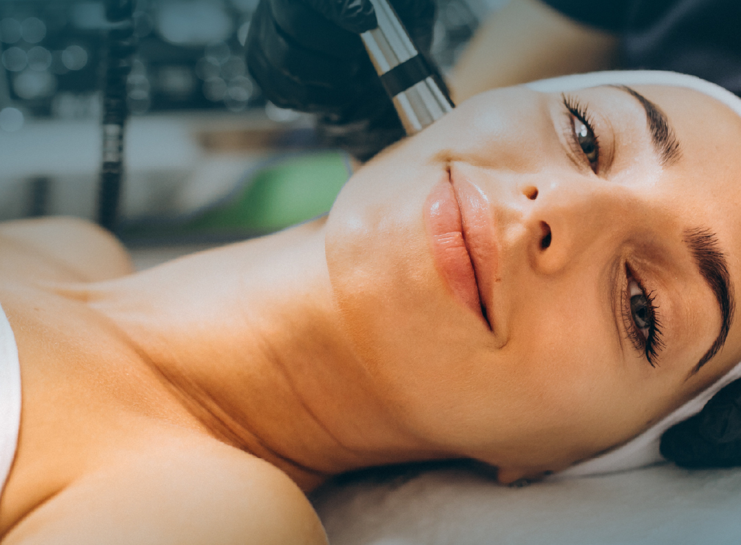 Close-up of PDO threads being inserted under the chin for a non-surgical neck lift.