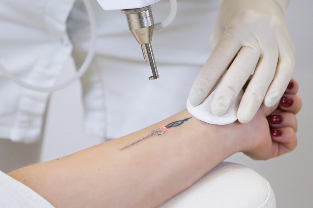 Close-up of a laser tattoo removal procedure in progress.