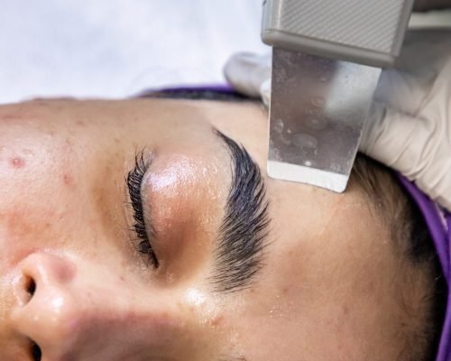 A patient receives laser wart removal treatment on a plantar wart located on the foot.