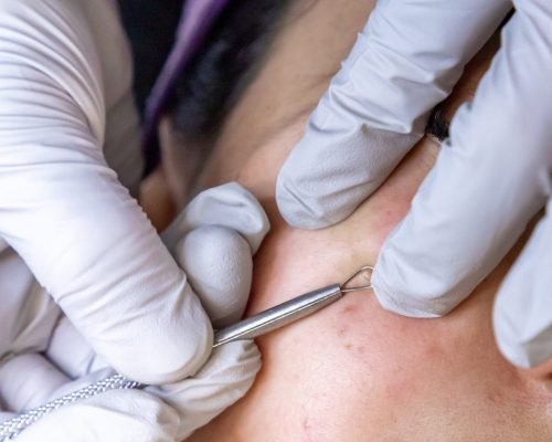 A dermatologist examines a patient's facial mole with a dermatoscope.