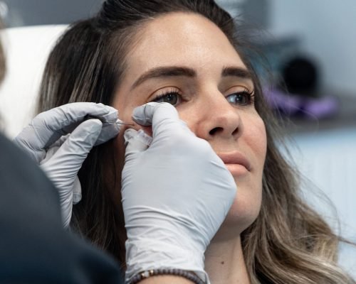 A syringe filled with hyaluronic acid filler, commonly used for lip injections and under-eye filler treatments.